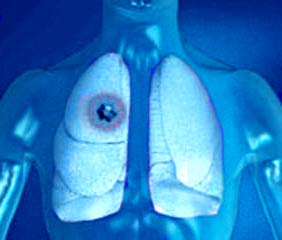 показывает ли флюорография рак легких