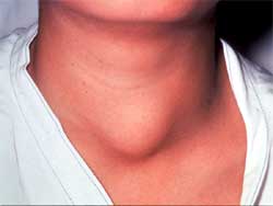 медуллярный рак щитовидной железы