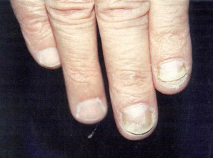 меланома ногтя