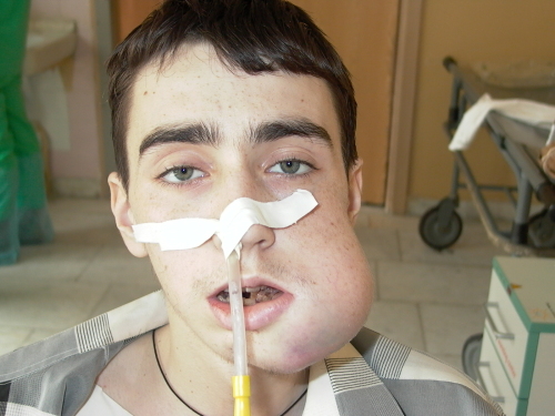 Лимфома Беркитта | Лечение онкологии в Израиле