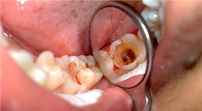 Как выглядит рак зуба